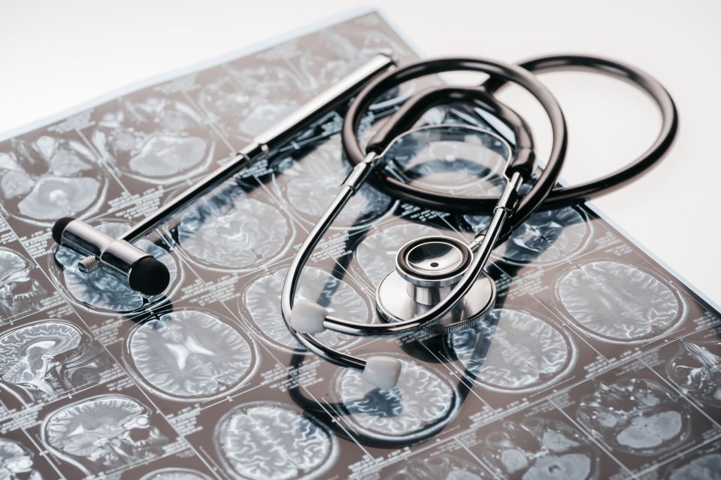 MRI result, stethoscope, and hammer in a table of neurologist.