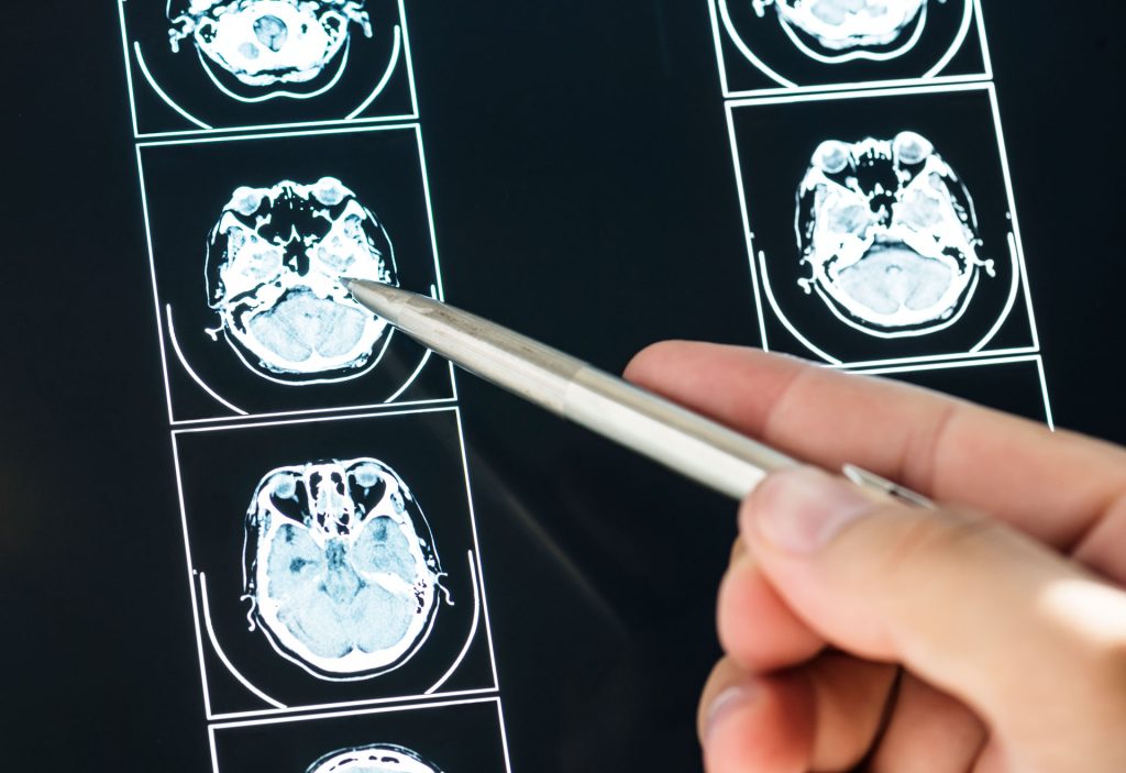 Closeup of brain MRI Scan.
